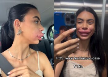Miss Pomerode tem inchaço extremo nos lábios após procedimento estético e viraliza: 'Usada de exemplo'