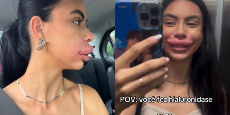 Miss Pomerode tem inchaço extremo nos lábios após procedimento estético e viraliza: 'Usada de exemplo'